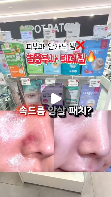트러블 염증주사 대체템🔥 피부과 갈 필요 없어❌

속드름까지 8시간 안에 진정시켜주는~ 속드름 패치의 정석!
💚대웅제약 이지덤 뷰티 퀵카밍 패치 @easyderm.official
(8매+응급앰플+핀셋 구성)

짜지지도 않고 땅땅한 속드름.. 
아프기만한 속드름 다들 경험한 적 있죠?🥵

원래는 트러블 나면 곪을 때까지 기다리거나 
피부과 가서 염증주사 맞고 짜고 관리하기 너무 불편했거든요ㅜㅜ

피부과 시술 대체템으로 너무 추천하는!!
자는동안 간편 케어 가능한 암살패치✨
이제 기다리지말고 바로 붙이면 돼요👍🏻

마그네슘 마이크로샷이 들어가있어서
진짜 8시간 안으로 어떤 트러블도 응.급.진.정❤️‍🔥

⭐️사용방법
STEP1 : 부착부위를 물기나 유분기 없이 깨끗하게 건조시킵니다
STEP2: 패치 가운데 부분이 손에 닿지 않도록 필름 제거
STEP3 : 집중 케어 부위에 앰플을 올린 패치를 수직 방향으로 누르며 부착합니다.
STEP4 : 부착 2-8시간 후 제거합니다.

딱 이거 하나만 붙이고 자고 일어나면,
속드름이 부풀지도 않고 쏙 들어가서 
저처럼 트러블로 고생이신 분들은 진짜 필수템이에요!

🫒올리브영 2월 오특행사
2/7(토) 단 하루동안만 34% 할인💰(14,900원 → 9,900원)
이 날 꼭 쟁여두시는거 추천드려요 !!

#대웅제약 #올리브영 #이지덤 #퀵카밍패치 #속드름패치 #여드름패치 #트러블케어 #올리브영여드름패치 #여드름패치추천 #피부관리 #스킨케어 #트러블 #염증주사 #트러블피부 #여드름 #여드름피부 #올리브영패치 #올리브영패치추천 #속드름 #트러블패치 #올리브영트러블패치 #올영추천템 #올영세일추천템 #올영세일 #오특